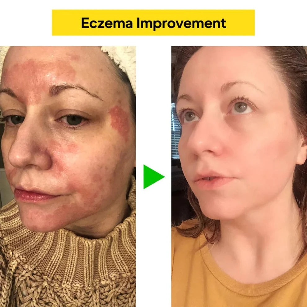 PureSkin Herbal Relief Cream – The Natural Eczema & Psoriasis Solution